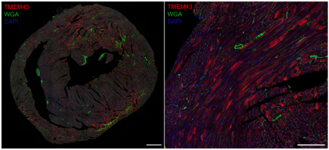 El Instituto de Ciencia de Materiales de Madrid (ICMM-CSIC) participa en una investigación que ha desarrollado una innovadora terapia génica que podría transformar el tratamiento de la miocardiopatía arritmogénica tipo 5 (ARVC5), una enfermedad genética cardiaca rara y extremadamente letal. Esta enfermedad, especialmente devastadora en hombres jóvenes, carece actualmente de cura, y los tratamientos disponibles solo ofrecen soluciones paliativas.
