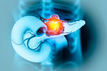 Ilustración cáncer de páncreas